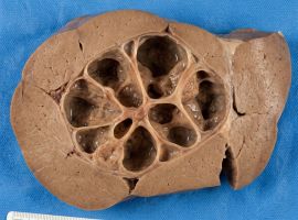 Complex Liver Cyst Illustration