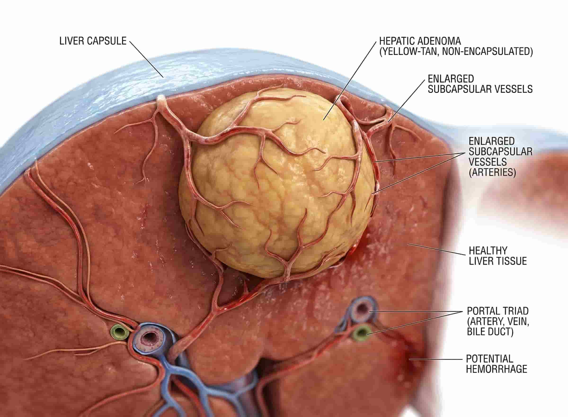 Benign Liver Masses Illustration
