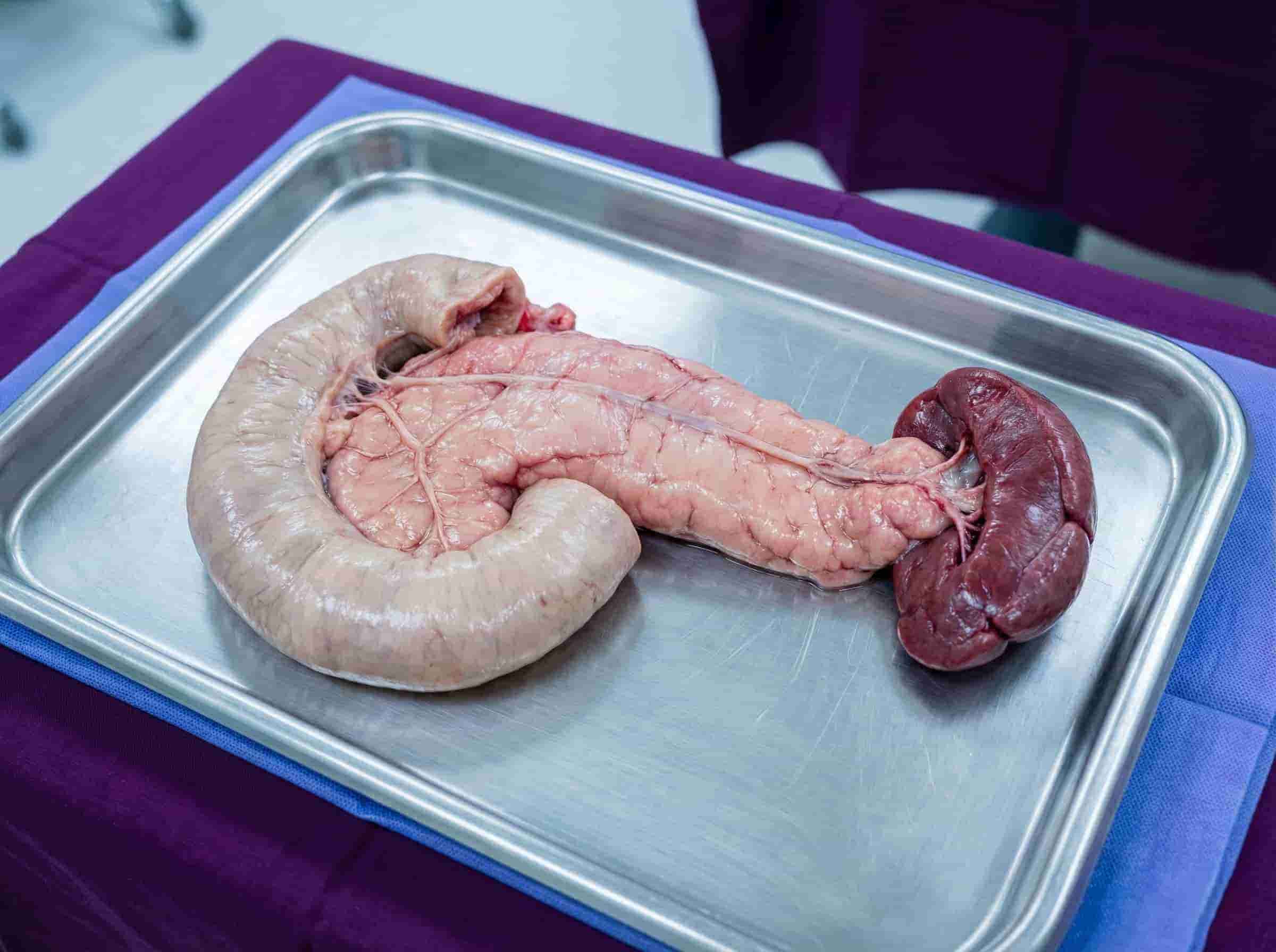 Total Pancreatectomy