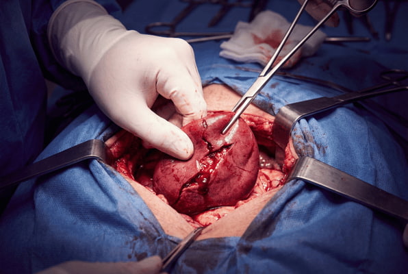 Spleen Surgery