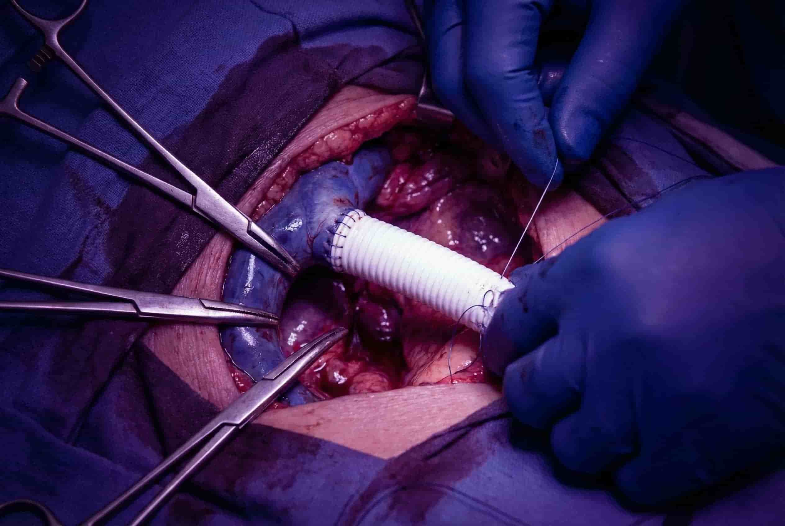 IVC Resection