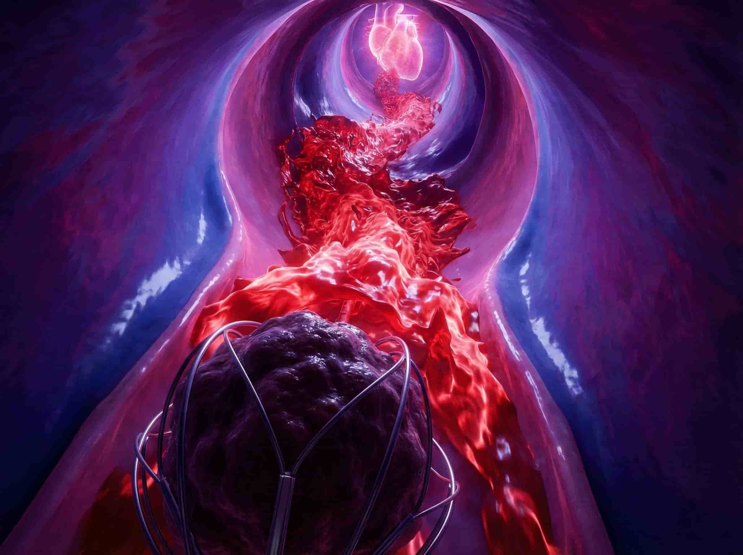 IVC Blockage Treatment