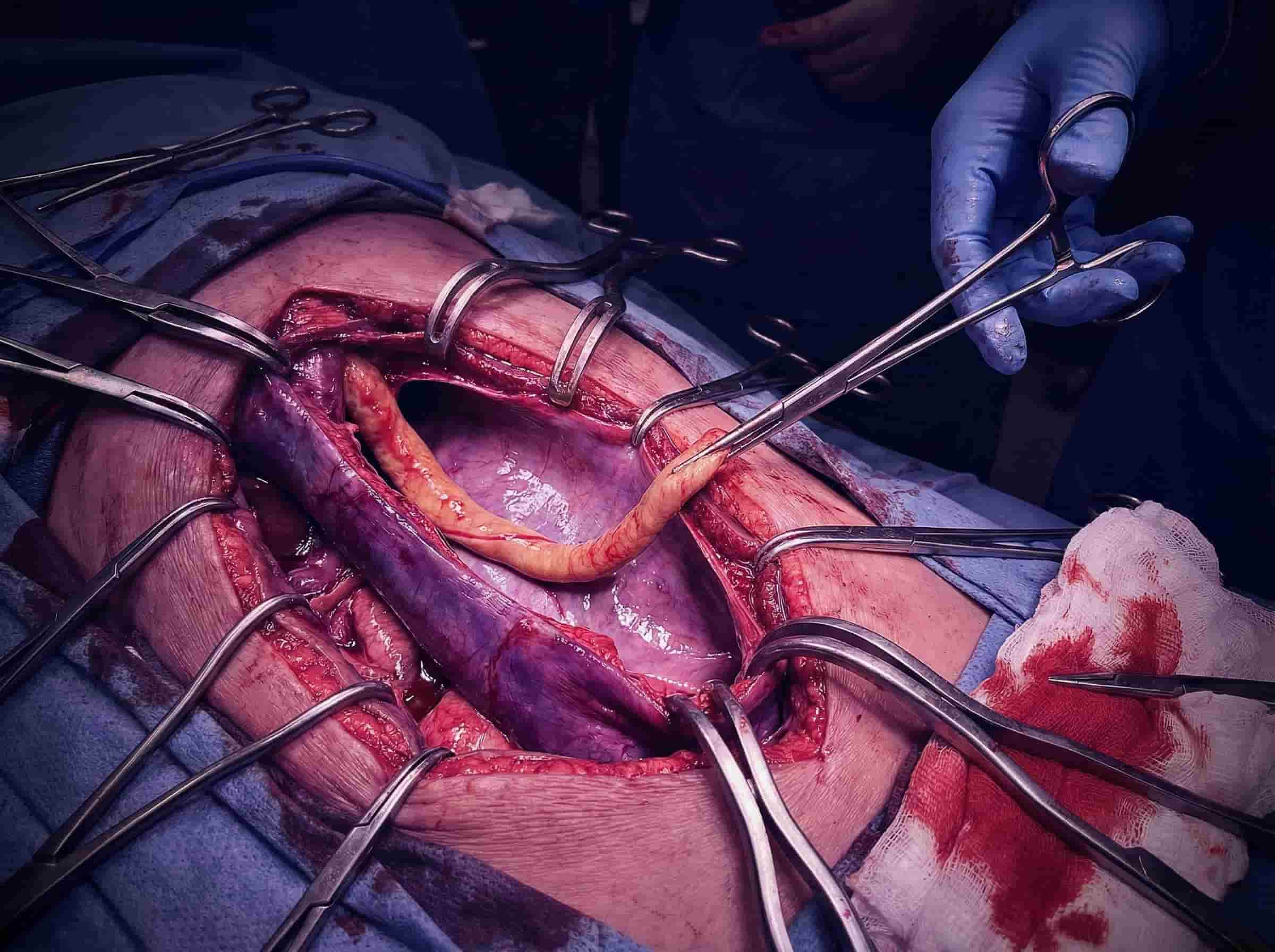 Renal Cell Carcinoma IVC Thrombus
