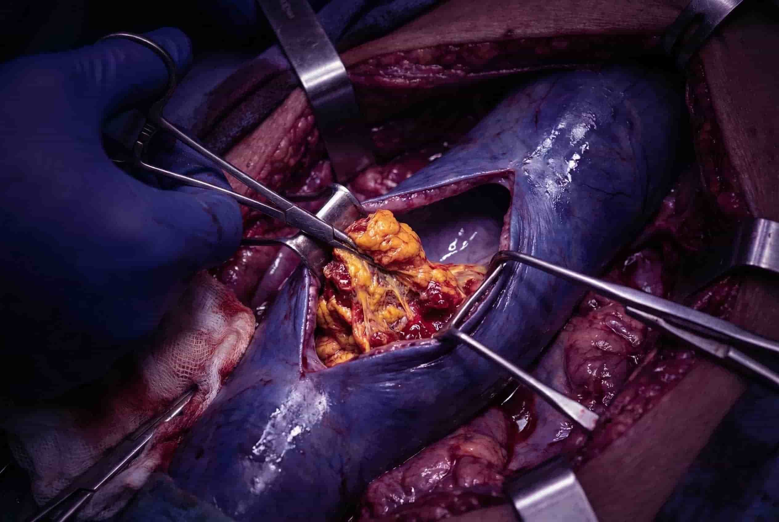 Vena Cava Thrombectomy