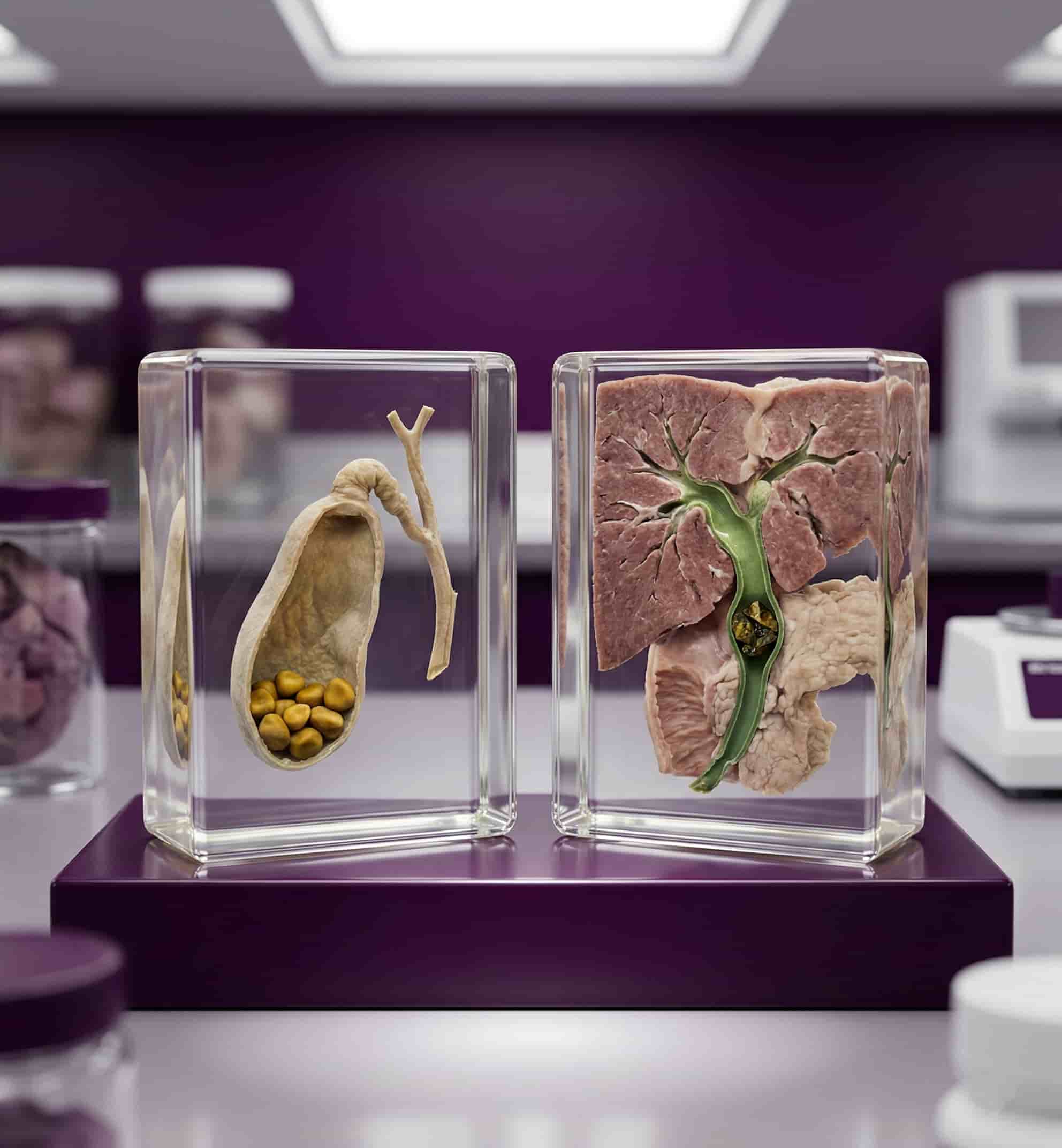 Comparison between Gallstones and Bile Duct Stones