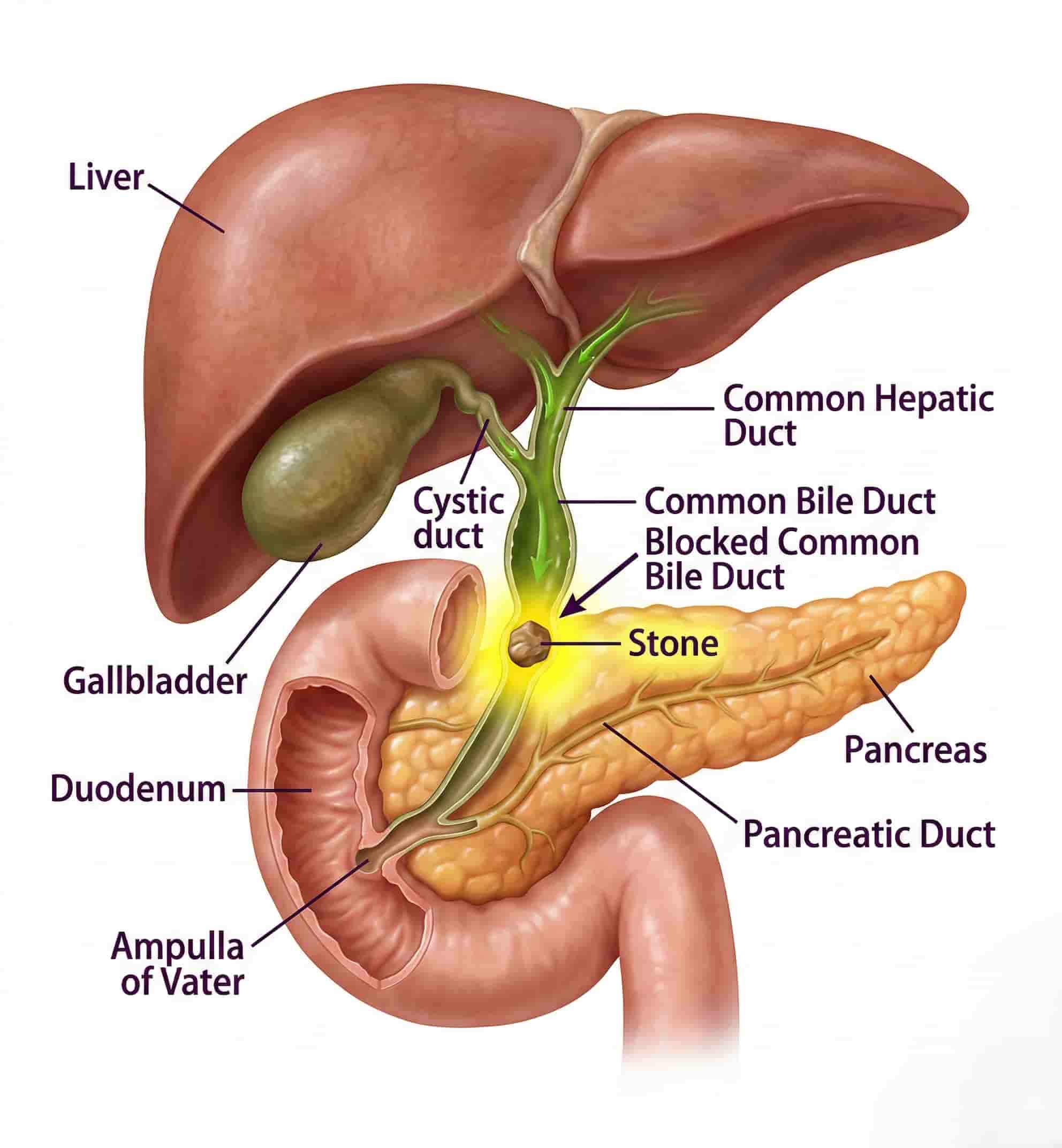 Bile Duct Stone Diagram