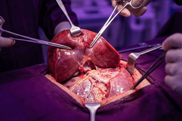 Liver Resection